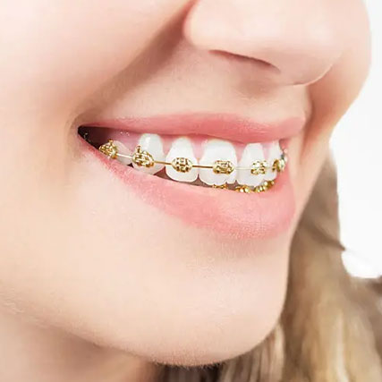 midas gold braces